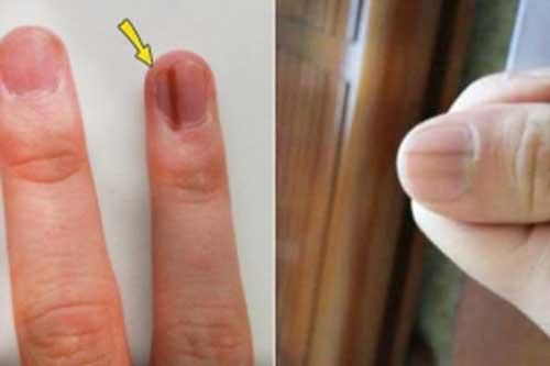 7 dấu hiệu khác thường trên móng tay cảnh báo bệnh nguy hiểm, đặc biệt là số 3