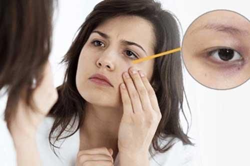 Bị quầng thâm mắt đừng tưởng do thiếu ngủ, có thể bạn đang gặp 1 trong 5 bệnh nguy hiểm