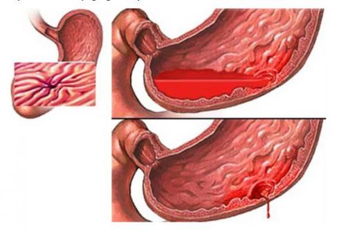 Xuất huyết tiêu hóa, xử trí thế nào?