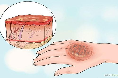 Cách chăm sóc vết bỏng bị vỡ