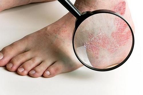 Mùa mưa, thận trọng nấm da chân