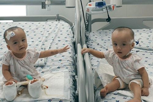 Song Nhi lần đầu chạm tay nhau sau ca mổ tách rời