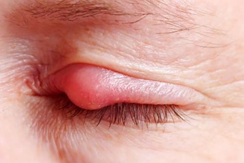 Tử vong khi tiêm thuốc trị lẹo mắt: Chữa thế nào chuẩn chỉnh?