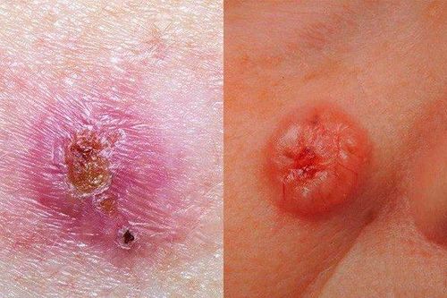 6 biểu hiện bất thường cảnh báo ung thư sớm