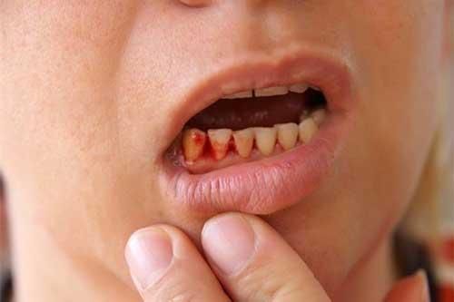 Mối hiểm họa không ngờ từ những chiếc tăm tre không phải ai cũng biết
