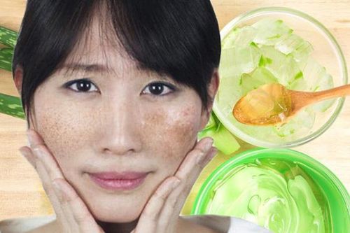 Da mặt láng không tì vết với 4 cách trị tàn nhang bằng nha đam