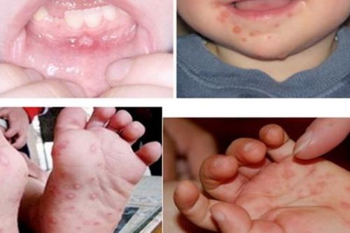 Bệnh tay - chân - miệng không đáng sợ khi chúng ta hiểu về nó