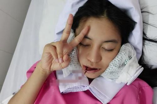 Gò má trở thành bộ phận tiếp theo để hotgirl Trang Anna 'đại tu nhan sắc'