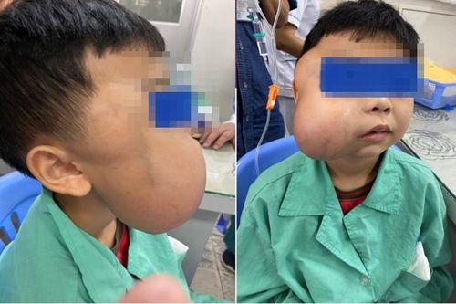 Khối u làm biến dạng khuôn mặt bé trai 13 tuổi lần đầu phát hiện ở Việt Nam