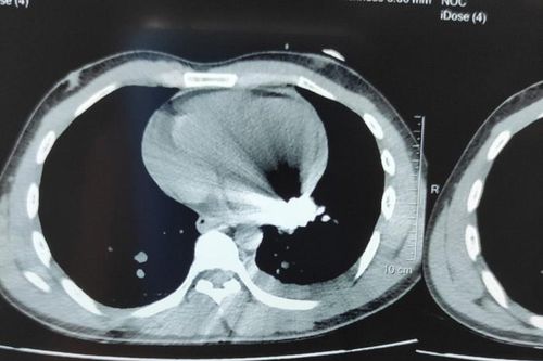 Cứu sống người đàn ông bị đạn nổ thủng tim khi đốt rác