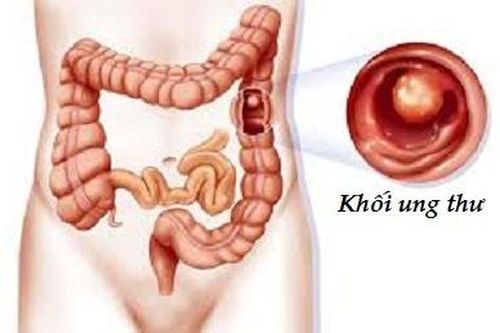 Thuốc trị rối loạn cương dương có thể kéo dài tuổi thọ cho bệnh nhân ung thư ruột kết