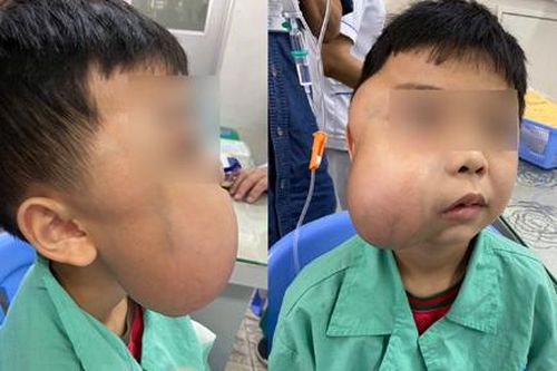 Cắt khối u vòm mũi họng khổng lồ cho bé trai 13 tuổi