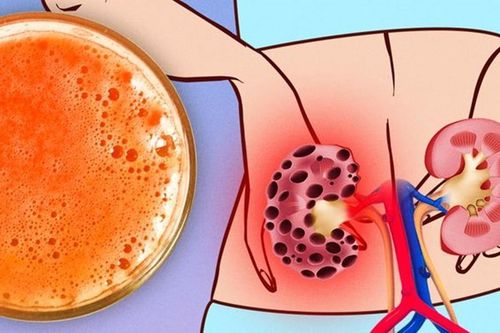 7 thực phẩm gây hại thận, bạn không nên ăn nhiều