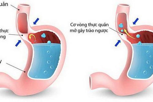 Cần phát hiện sớm co thắt tâm vị