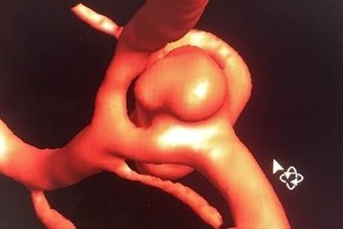 Cứu sống nữ bệnh nhân bị xuất huyết do vỡ phình mạch máu não