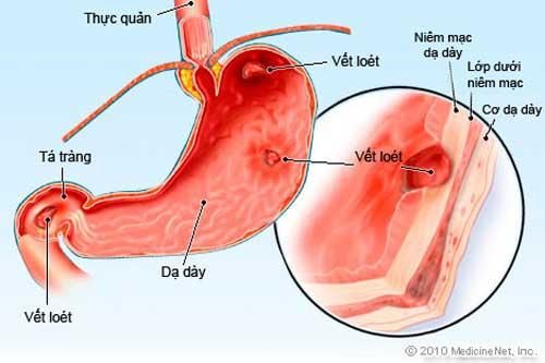 Những thực phẩm 'đại kỵ' với người đau dạ dày