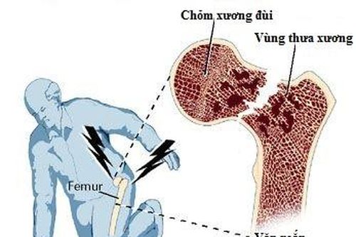 Tránh nguy cơ gãy xương vùng khớp háng ở người cao tuổi