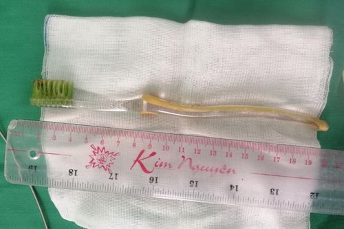Lấy bàn chải đánh răng nằm trong bụng bệnh nhi 13 tuổi