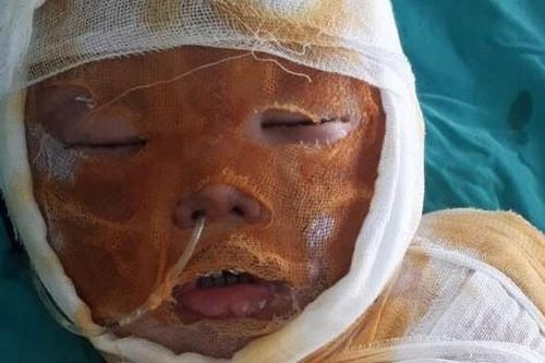 Xót xa bé trai 4 tuổi bị bỏng nặng cần tiền hỗ trợ để cấy ghép da