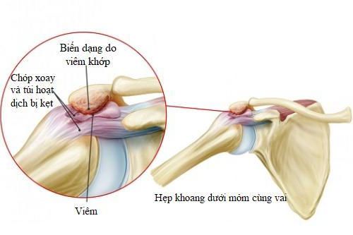 Đau vai do hẹp khoang dưới mỏm cùng vai