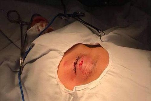 Bé trai 9 tuổi bị ghi đông xe đâm vào mắt