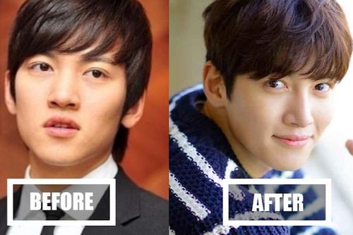 Netizen Hàn bối rối khi so sánh ảnh trước và sau phẫu thuật mũi của Ji Chang Wook