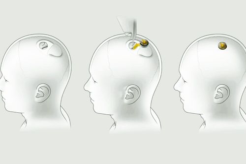 Công nghệ cấy chip vào não người của Elon Musk