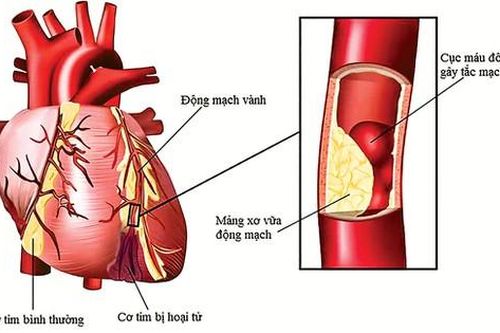 Những biểu hiện bệnh động mạch vành