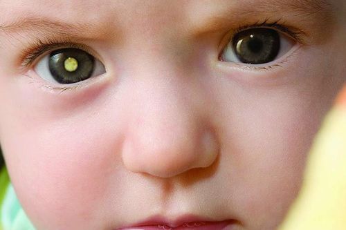 Đục thủy tinh thể ở trẻ em và những điều có thể các mẹ chưa biết