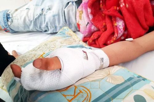 Hà Giang: Điện thoại phát nổ, bé trai 9 tuổi dập nát bàn tay