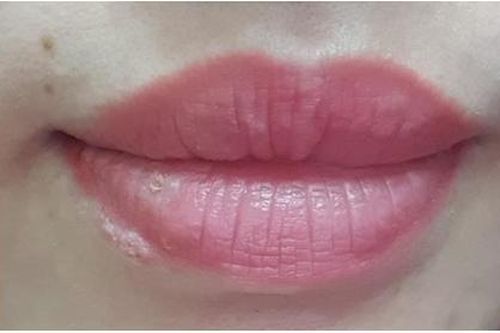 Cảnh báo nhiễm herpes khi xăm môi