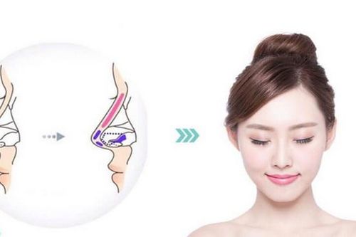Bị viêm xoang có nên nâng mũi?