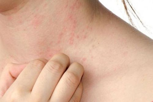 Giải pháp hỗ trợ làm giảm triệu chứng bệnh mề đay