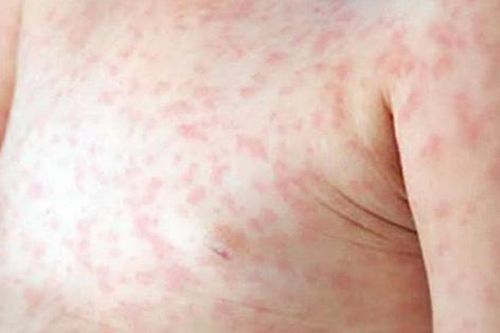 Kinh nghiệm đánh bại sốt phát ban thời Thế chiến II