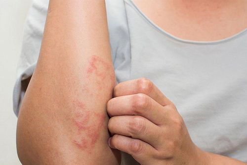 Căn bệnh về da khiến phụ nữ rơi vào khủng hoảng tinh thần trầm trọng