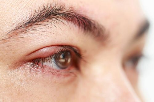 Cách chữa lẹo mắt hiệu quả