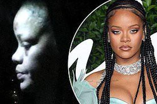 Rihanna lộ mặt tím bầm, sưng húp khiến fan lo lắng