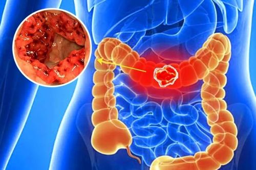Kịp thời phẫu thuật cứu bệnh nhân 85 tuổi bị ung thư đại tràng