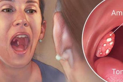 Viêm amidan ở người lớn: Làm gì để phòng ngừa hiệu quả?