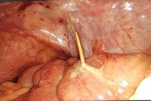 Hà Nội: Người đàn ông bị thủng ruột do vô tình nuốt que tăm