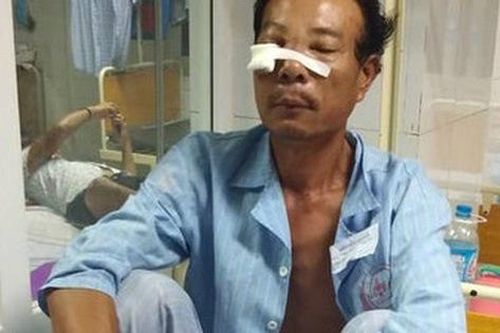 Cãi nhau chuyện cống nước, người đàn ông bị hàng xóm dùng búa sắt đánh vào mặt