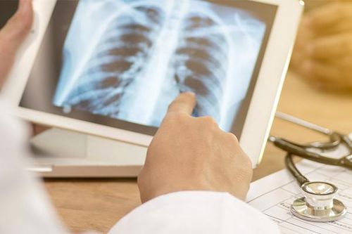 Lý do nhiều người bị ung thư phổi dù không tiếp xúc với khói thuốc