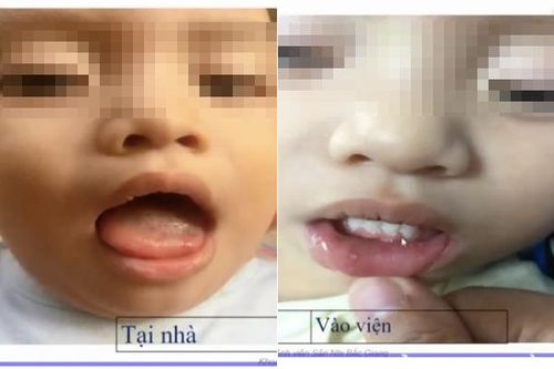 Bé 1 tuổi mắc tay chân miệng tổn thương não, 3 dấu hiệu sớm báo bệnh nặng