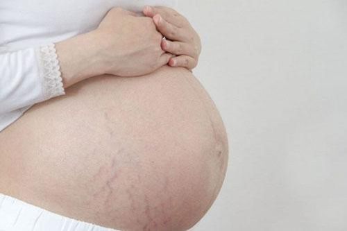 Mách chị em 5 bí kíp chống rạn da khi mang bầu, giữ lại làn da bụng mềm mại như thời con gái