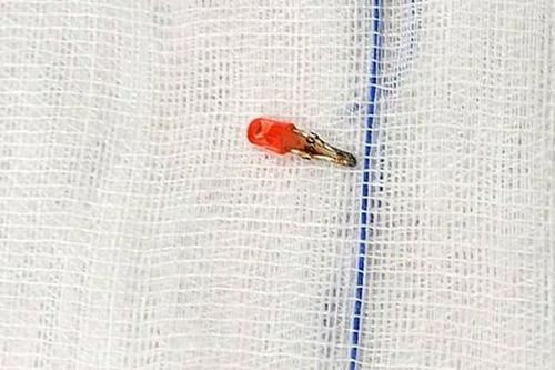 Đèn nhựa điện thoại đồ chơi nằm trong phế quản bé gái 10 tháng tuổi