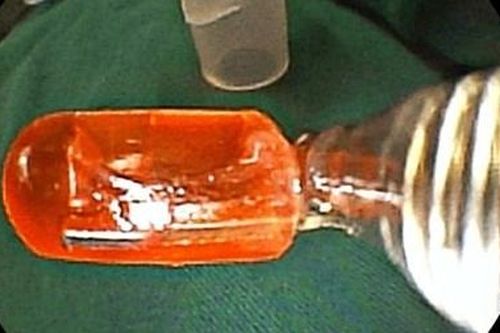 Bé 10 tháng tuổi nuốt đèn LED điện thoại đồ chơi