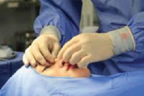 Dịch tiết ra nhiều sau khi nâng mũi, cần làm gì?