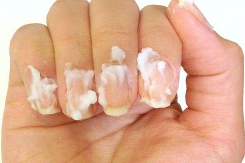 Tác dụng phụ khi dùng thuốc trị nấm móng