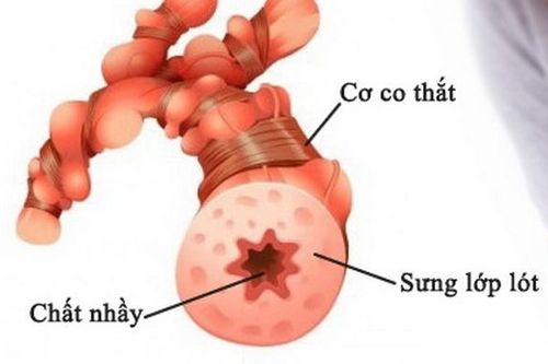 Bệnh nhân hen suyễn nếu mắc COVID-19 sẽ rất nguy hiểm
