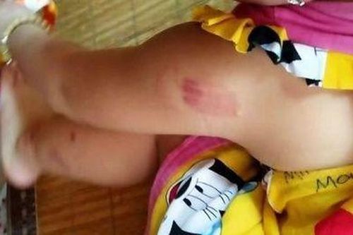 Bé gái bầm tím người khi đi học là do bị bạn cắn?